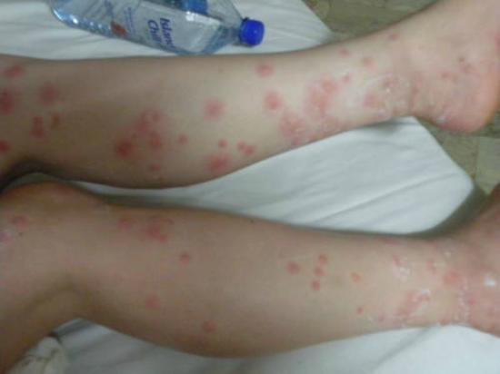 Picture Of Bed Bugs Bite On Legs