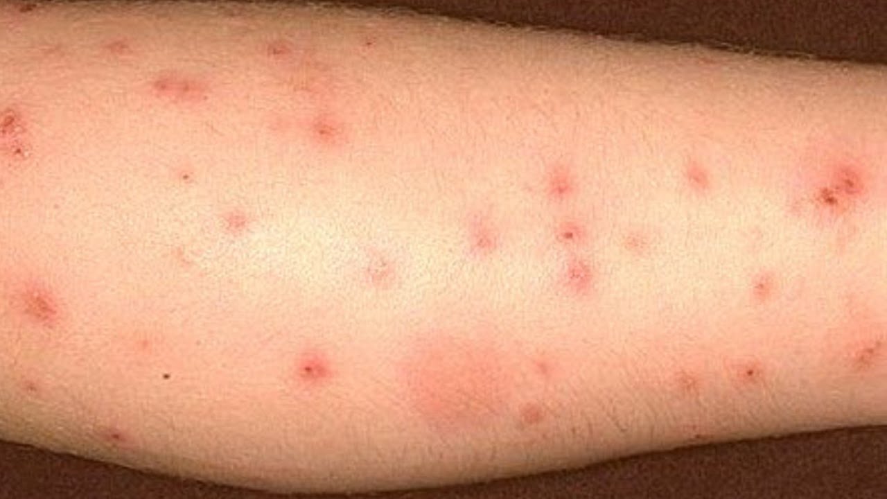 Bed Bug Rash Picture