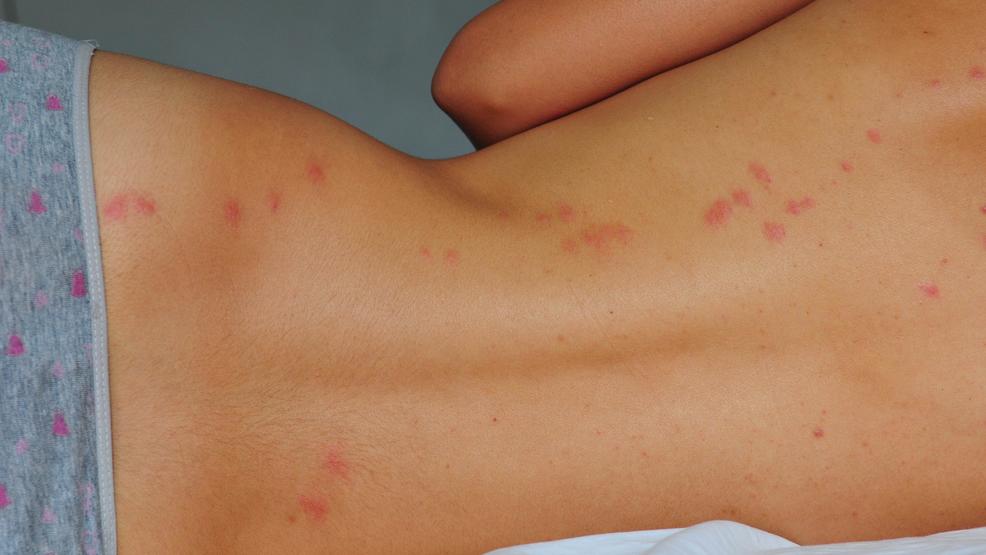 Picture Of Bed Bugs Bite On Humans