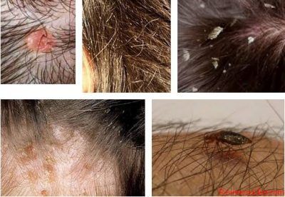 Pictures Of Bed Bugs And Head Lice In Hair