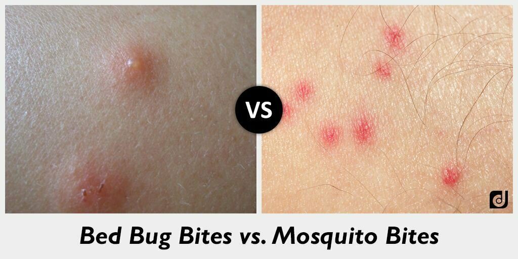 Difference between bed bug bites and mosquitoes bite